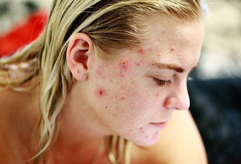 ایجاد آکنه بر اثر استرس-acne